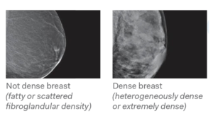 Breast Density 1