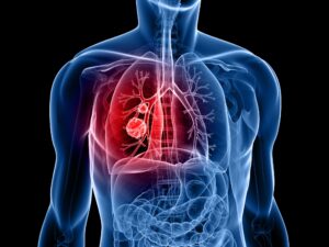 Lung Cancer Screening Saves Lives